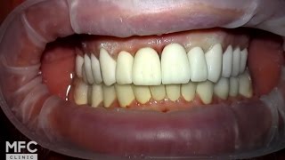 Протезирование зубов.  Фиксация временных коронок. Часть 1.