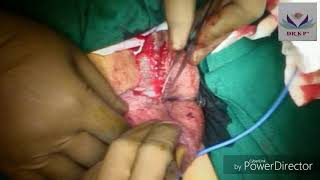 Penoscrotal transposition surgery by Dr. Kalpesh Patil, pediatric surgeon, Pune