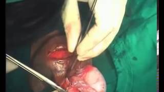 Orchidectomy and orchidopexy in Testicular Torsion - InguinoScrotal By Dr.Sherif Saleh