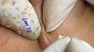 Stab and spear blackhead pulls (79) | Loan Nguyen