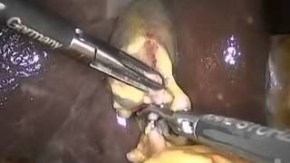 Лапароскопическая холецистэктомия. Laparoscopic holetsistektomiya