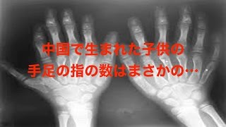 中国で生まれた多指症の子供！その数は世界記録を更新するものだった《衝撃》