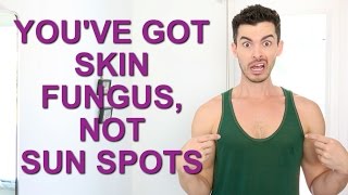 YOU'VE GOT SKIN FUNGUS, NOT SUN SPOTS