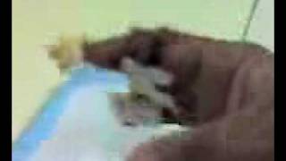 fingers amputated and re-attched