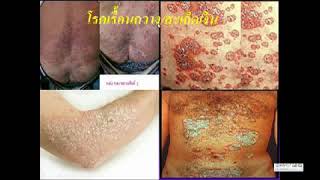 คัมภีร์ วิถีกุฏฐโรค