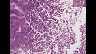 Histopathology Uterus--View 1 Endometrial adenocarcinoma, Vi