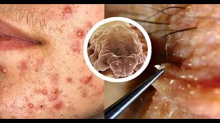 Она думала, что ее прыщи — это гормональное! Врач потерял дар речи, когда ПОСМОТРЕЛ В МИКРОСКОП