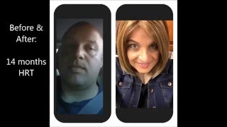 18 months male to female (MtF) transition, 17months HRT, 45yo
