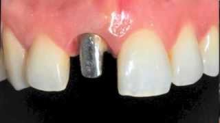 Couronnes céramiques et facettes dentaires/All ceramic crowns and veneers
