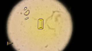 Трипельфосфаты в моче!  Tripolphosphates in the urine!