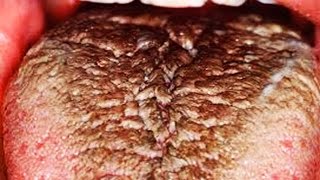 Black Hairy Tongue, Gross Fissured Tongues & Tongue Health