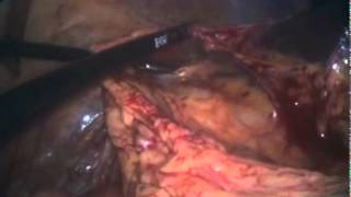 Colectomie totale laparoscopique avec Enseal
