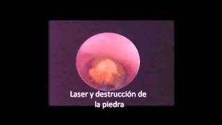 video laser cirugia piedras vias urinarias