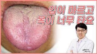 혀뿌리 백태 - 입이 마르고 목이 너무 타요 / 구강건조증 인후건조증