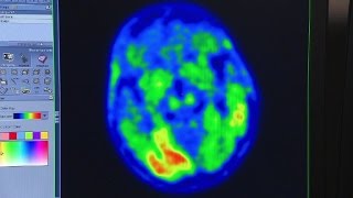 Tau and Alzheimer's