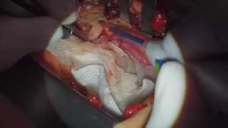 MIDCAB (Minimally Invasive Direct Coronary Artery Bypass Grafting)