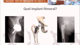 Prothese totale de hanche chez sujet jeune. Clinique du sport Drs Cordier et Prévot