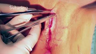 Labiaplasty Surgery Part 2 | Detailed Procedure by Dr. Hanna, Oxnard, Ventura County