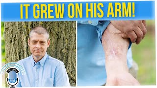 Man Loses Penis to Infection, Doctor Builds New One on His Arm (ft. Anthony Lee)