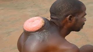 Man's Giant Back Growth - Case Report with Watson