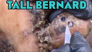 Tall Bernard's BIG Jigger Removal - Part 3