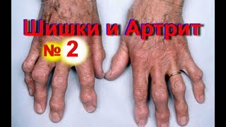 Шишки на пальцах рук- как избавиться от шишек на пальце - № 2 | Артрит суставов на руках