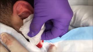 Dr. G's Best Infected Cysts, Skin Tags & Pimple Pops;  Important Message