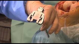 Prothèse du genou à plateau mobile avec équilibrage ligamentaire