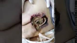 Horrible wound (bedsore).пролежень гигантских размеров