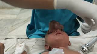 Intubation of 3 months 4.5 kg child with frontal nasal encephalocele