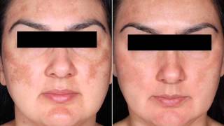 Obagi Nu Derm: Before & After Results