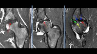 MRI Hip Case 02