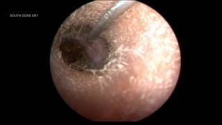 IMPACTED EAR WAX WITH PUS