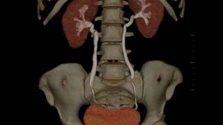 MDI Radiology CT IVP 3D