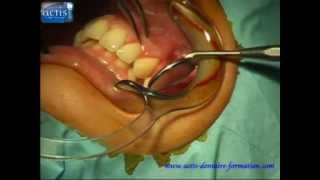 Actis Dentaire Formation : greffe conjonctive enfouie canine (connective tissu graft)