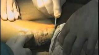 Ампутация нижней конечности - amputation of foot