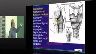 NEETPG Coaching ENT Class Dr. Murali Bharadwaz 3rd April 2013 ENT Topic - 2 Larynx carcinoma