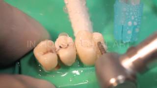 Inlay Onlay - [ In-House Dental Art ]