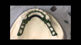 How to construct and sprue a wax pattern for a Co/Cr RPD using the Siladent spruing system
