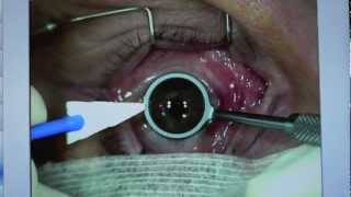 LASEK procedure