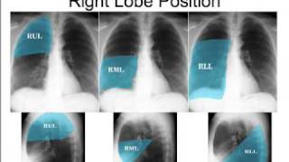 CXR - How to read the chest x ray - Part I: Concepts and Quality