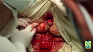 Лазерная геморроидэктомия. Наружный геморрой. ДНМУ г. Дружковка Hemorrhoidectomy