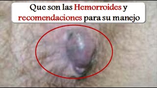 HEMORROIDES: Recomendaciones para el manejo de las Hemorroides