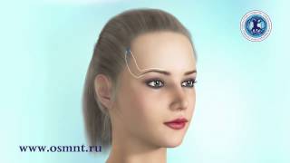 ОСМНТ OSMNT схема установки нитей конфигурации "C"  Promoitalia Dermafil Happy Lift