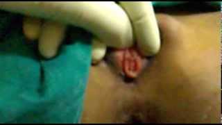 mayor rokitansky syndrome (Vaginal Orifice)