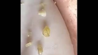 Новое выдавливание ПРЫЩЕЙ и ЧЕРНЫХ ТОЧЕК! Blackheads- Acne(Part 106)