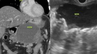 EUS Correlates of Disconnected Pancreatic Duct Syndrome