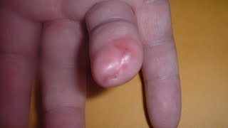 Amputated Finger Reverse Healing Time Lapse