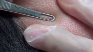 Father's day Pop- Blackhead Extractions - Natalie's Creations