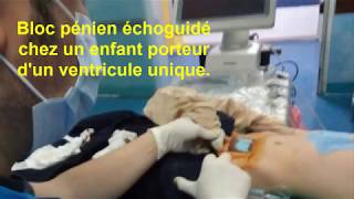 Bloc pénien sous échoguidage chez un enfant porteur d'un ventricule unique